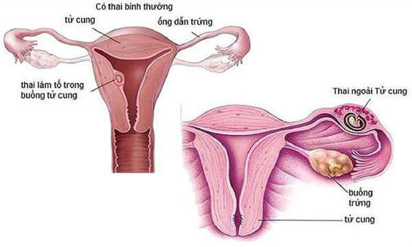 Chăm Sóc Sau Khi Điều Trị Thai Ngoài Tử Cung